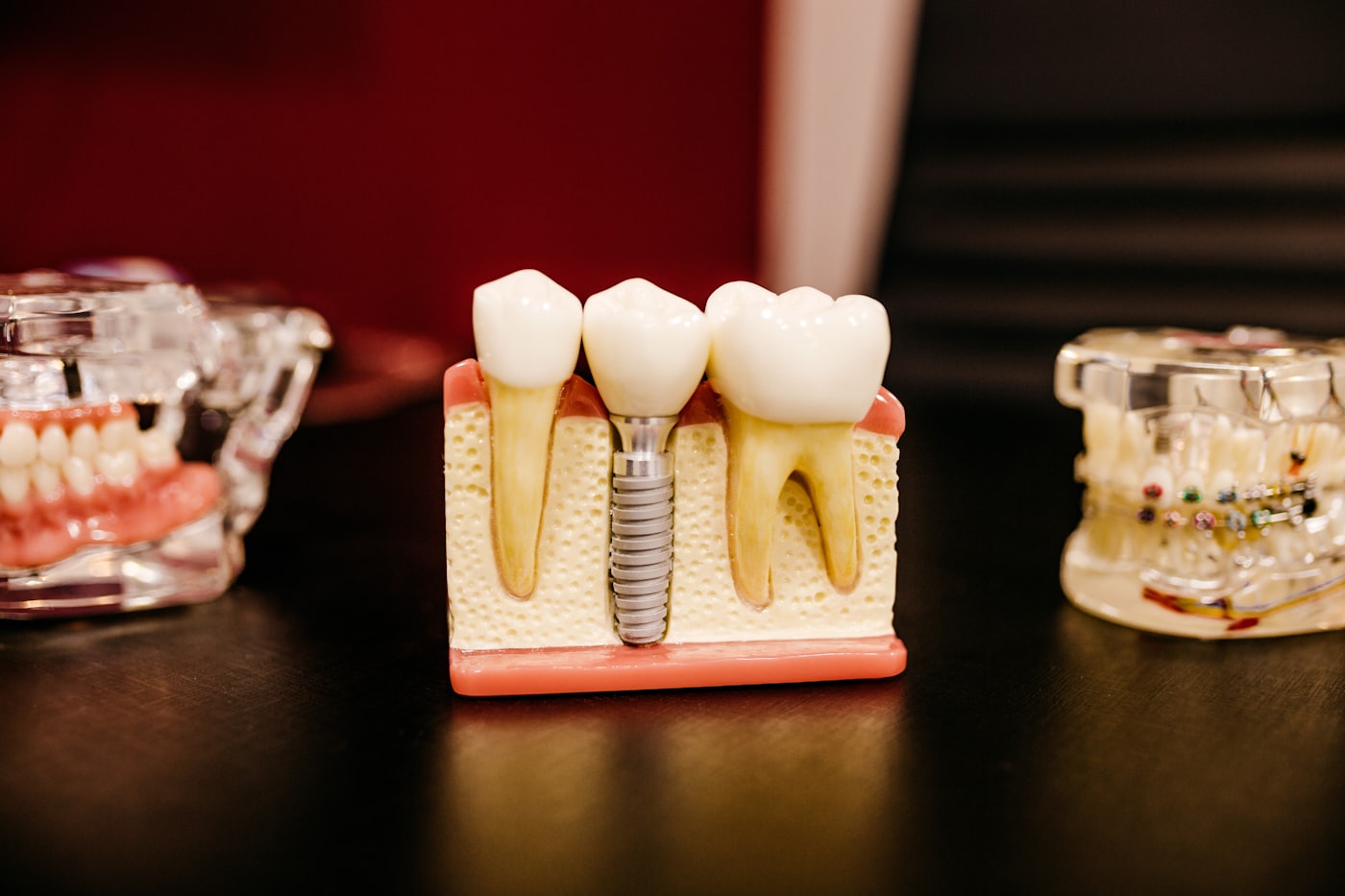 Dental implant model showing a titanium implant in the jaw