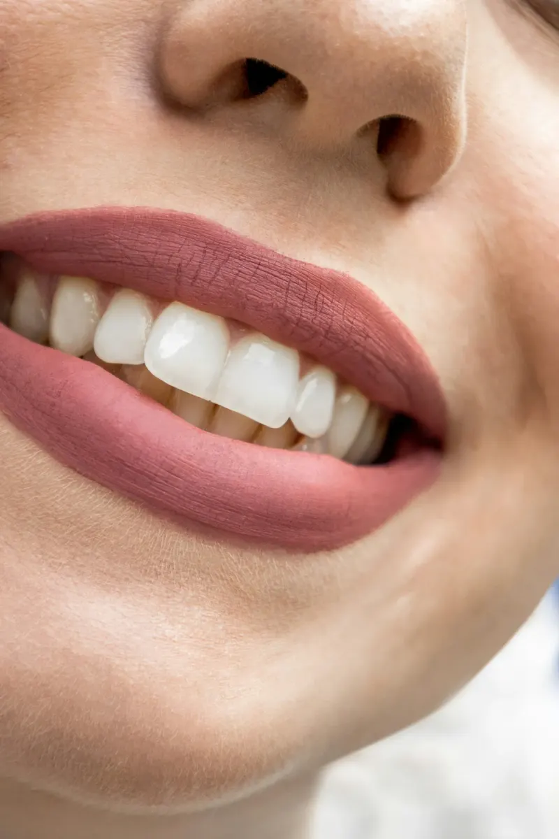 Teeth Polishing in Indore